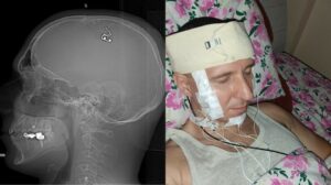 Seorang Peneliti Rusia Nekat Pasang Chip di Otaknya Modal Nonton Video di Youtube